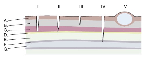 Classification des sinus dermoïde en 5 catégories. (Kiviranta AL et al) Légendes : A Peau ; B Tissus sous-cutané ; C muscle ; D Ligament supra-épineux ; B Os ; F Dure-mère ; G Moelle épinière 